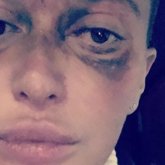 Девушка ослепла на один глаз после инъекции у косметолога в Москве