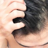 Бастағы биттен қалай құтылуға болады? - трихолог кеңесі