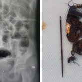 14 жастағы қыздың ішегінен бір уыс шаш пен ине шықты