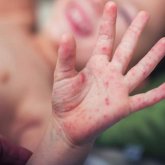 Балаларды Кавасаки синдромынан қорғау жолдары қандай? - маман жауабы