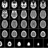 29 жастағы келіншек миына екі ине қадалғанын ұзақ жылдар бойы білмеген