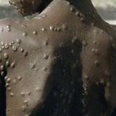 Маймыл шешегінің Қазақстанға келу қаупі бар