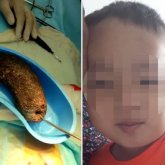 Төрт жасар баланың асқазанынан бір жарым келі шаш шықты