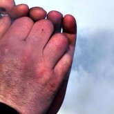 Үсік шалған адамға алғашқы көмек қалай көрсетілуі керек