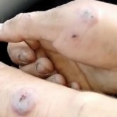 Қостанайлықтар сібір жарасын жұқтырғандар туралы қорқынышты видеоны таратып жатыр