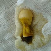 Жамбыл облысында тоғыз айлық бала емізігін жұтып қойған