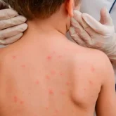 Қызылша: себептері, белгілері, диагностикасы, емі және алдын алу