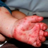 Астанада қызылшадан ем алып жатқан бала саны 200-ге жетті