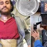 Миына Илон Масктың чипін салдырған адам өмірінің қалай өзгергенін айтты