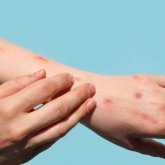 Астана әуежайында жолаушыдан маймыл шешегі анықталғаны рас па?