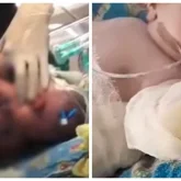 Семейдегі перзентханада дәрігерлер жаңа туған нәрестені күйдіріп алған