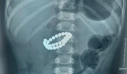 Алматыда екі жасар бала 31 магнит жұтып қойған