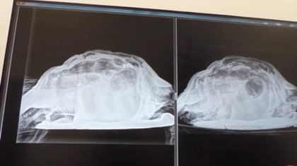 Дәрігерлер британдық қыздың қынабынан тасбақа алып шықты