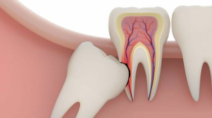 Ақыл тістерді жұлдырған дұрыс па?