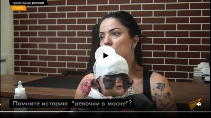 «Бэтменнің маскасымен» дүниеге келген сәбиге бірнеше рет операция жасалды (ВИДЕО)