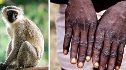 «Қазақстанда маймыл шешек ауруы анықталған жоқ» – Санитарлық бақылау комитеті