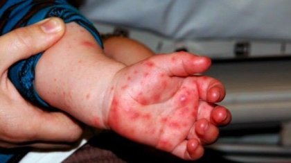 Астанада күніне 75-80 бала қызылша жұқтыруда