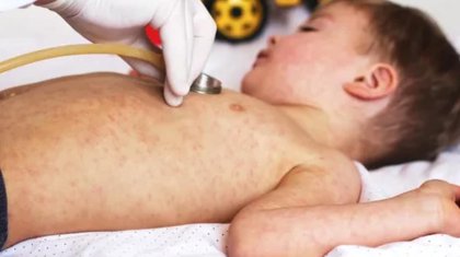 Ақтөбеде қызылша жұқтырған бес бала жансақтау бөліміне түсті