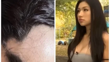 «Өз ақшама денемді бүлдіріп берді»: 22 жастағы қазақстандық қыз пластикадан кейінгі жағдайын айтты