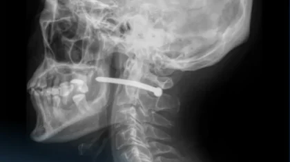 Петропавл тұрғыны мойнына шеге қадап алған