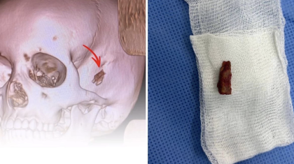 10 жастағы баланың басынан 5 жыл бұрын кіріп кеткен бұтақтың бір бөлігі алынды