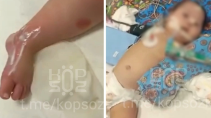 Астанада 9 айлық сәби ауруханада күйіп қалған