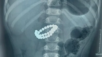 Алматыда екі жасар бала 31 магнит жұтып қойған