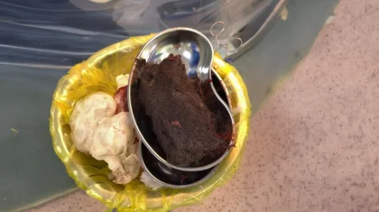 Түркістандық дәрігерлер 15 жасар қыздың асқазанынан 1 келі шаш алып шықты